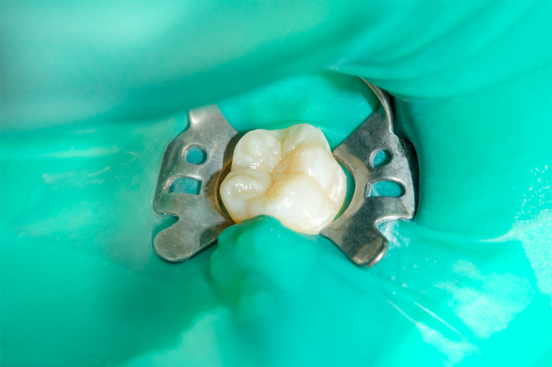 Understanding Dental Fillings: Types, Benefits, and Procedure, Cosmo Dental, San Francisco, CA